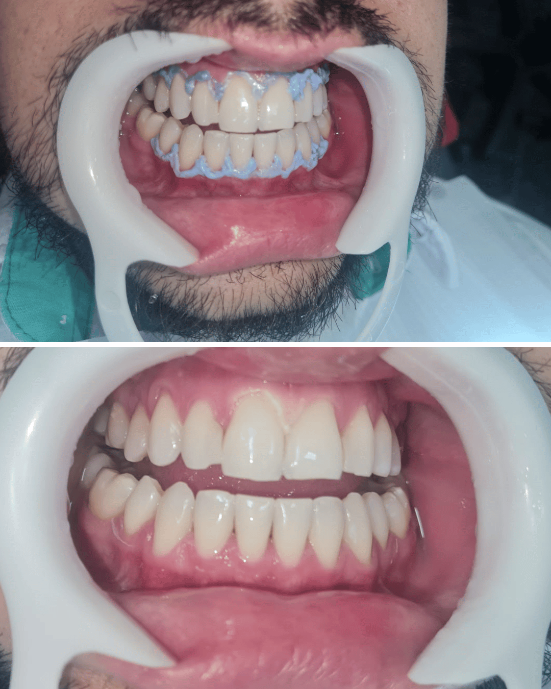 clareamento dentário